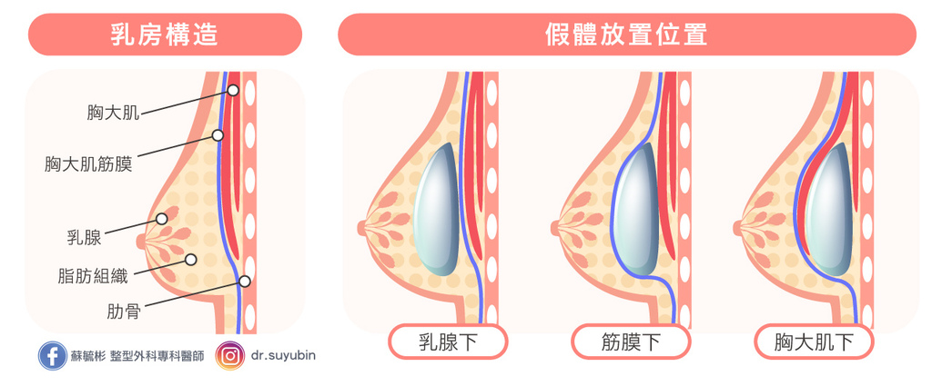 隆乳手術位置.jpg