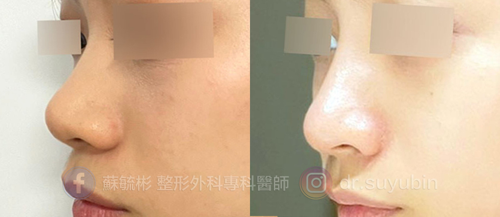隆鼻-02.jpg 隆鼻-02.jpg