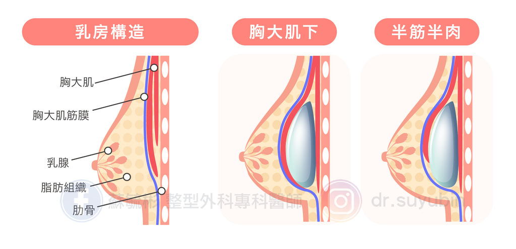 瘦 隆乳.jpg