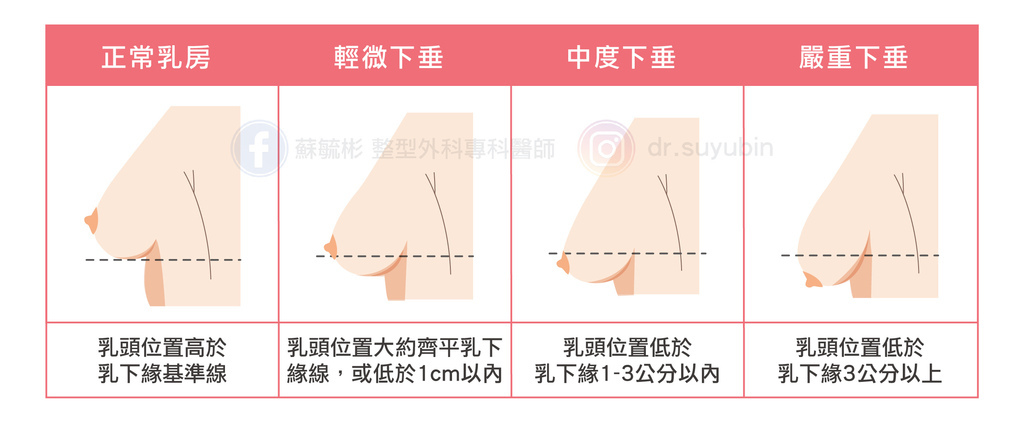 乳房下垂自我檢測.jpg