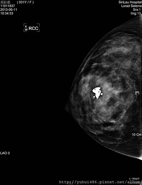 20130611-鈺惠-乳房攝影(1)