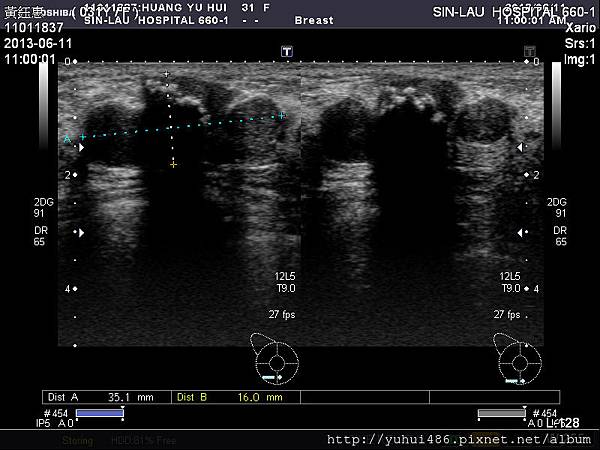 20130611-鈺惠-乳房超音波(1)