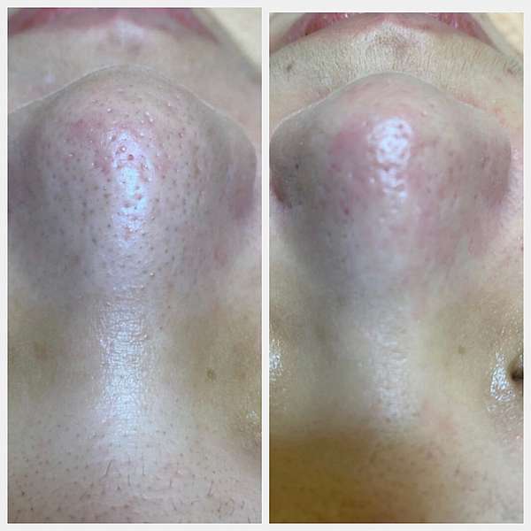 台北中山區做臉推薦 無痛清粉刺 美麗仙境美學館讓妳舒服到睡著 瑞拉的美食飛行旅遊 痞客邦