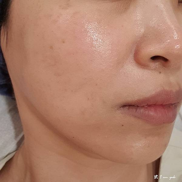 韓國水光針體驗。后界健康美學診所。收縮毛孔、淡化細紋、改善黑