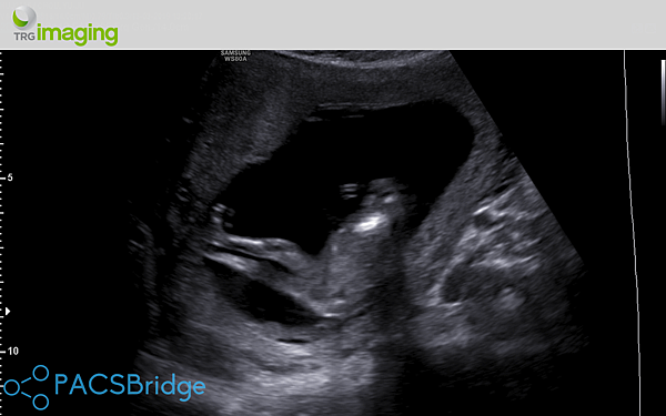 Ultrasound 12WKS - 9.png