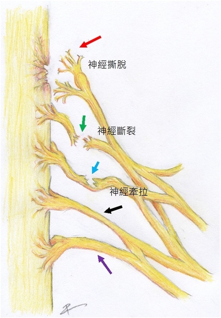 臂神經叢損傷治療的新進展-4-1.jpg