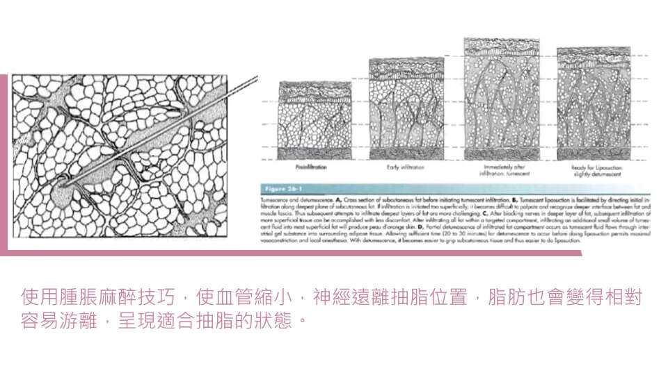 顯微套管抽脂【抽脂】為什麼不需全身麻醉？ 達到抽脂高度安全-1030-3.jpg