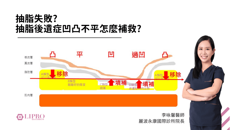 背部抽脂失敗修復成功案例分享—   不用懷疑背部抽脂失敗就是能透過抽脂重修來修復的-1103-8.png