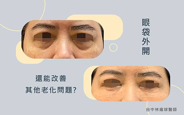 眼袋外開案例 首圖 眼袋外開案例 首圖