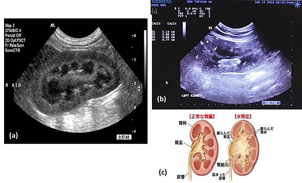 2019-01-15_腎臟超音波比較.jpg