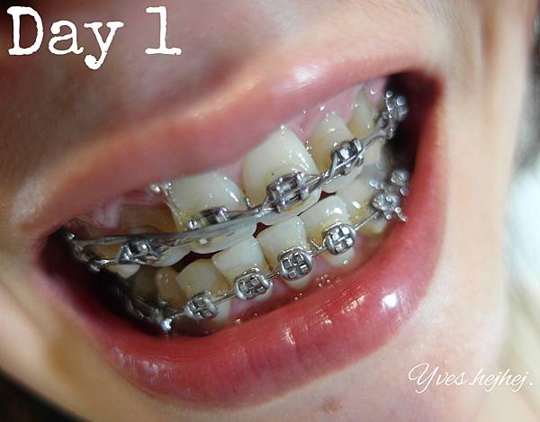 【牙齒齒白】誰說戴牙套不能亮白牙齒? 每一次刷牙都是齒白的開始 Li-ZEY 萊思 藍光光速白牙膏_極致齒白系列