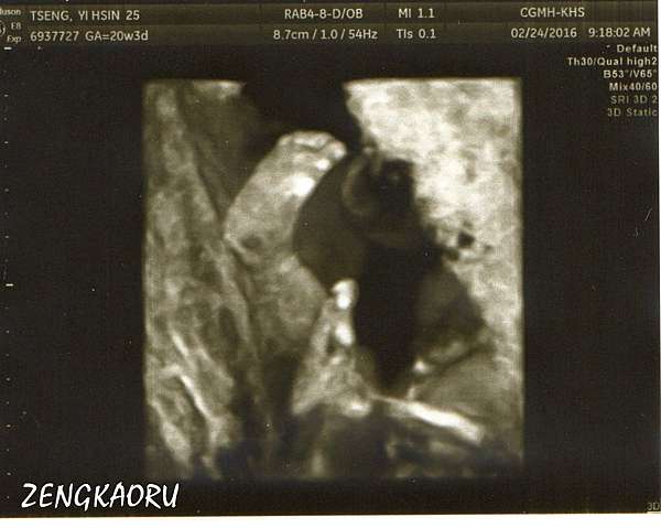 白帥帥20週 高層次超音波經驗 派大馨的走跳人蔘 痞客邦