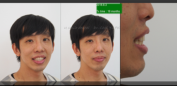 齒性三類咬合厚道案例1 不拔牙骨釘全齒列後退 翟聿飛醫師撰寫 翟聿飛醫師 痞客邦 齒性三類咬合厚道案例1 不拔牙骨釘全齒列後退 翟聿飛醫師撰寫 翟聿飛醫師 痞客邦