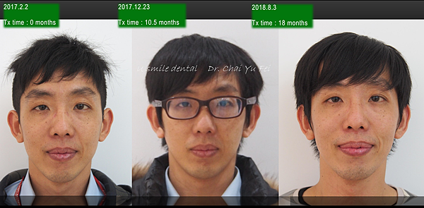 齒性三類咬合厚道案例1 不拔牙骨釘全齒列後退 翟聿飛醫師撰寫 翟聿飛醫師 痞客邦 齒性三類咬合厚道案例1 不拔牙骨釘全齒列後退 翟聿飛醫師撰寫 翟聿飛醫師 痞客邦