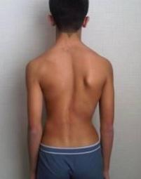 脊柱側彎.JPG 脊柱側彎.JPG