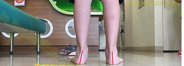 走路內八.內八矯正.扁平足矯正.足弓問題.足弓疼痛.腳底疼痛.腳跟疼痛.腳掌疼痛.足底筋膜炎.腳底筋膜炎.鞋墊.矯正鞋墊.足弓鞋墊.量身訂製鞋墊.高足弓.抽筋.小腿痠痛.小腿緊.無法久站.久走.矽膠鞋墊.氣墊鞋.軟鞋墊.專業鞋墊.推薦.高雄.屏東.台東.左營.鳳山.台中.彰化.桃園.苗栗.新北.新竹.澎湖 (4).jpg