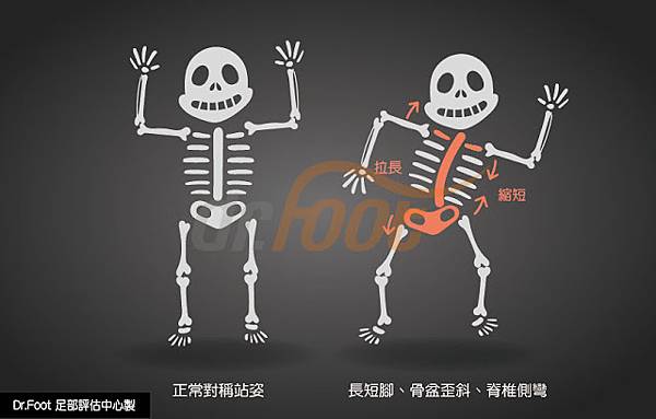 長短角脊椎側彎骨頭.腰痠背痛.臀部痛.長短腳.坐骨神經痛.脊柱側彎.脊椎側彎.肩頸痠痛.脖子痛.肩膀痛.腳麻.腳痛.拇指外翻.足底筋膜炎.腳底筋膜炎.腳痛.腳跟痛.前腳掌痛.扁平足.高足弓.矯正.訂製鞋.高雄.鳳山.左營.jpg 長短角脊椎側彎骨頭.腰痠背痛.臀部痛.長短腳.坐骨神經痛.脊柱側彎.脊椎側彎.肩頸痠痛.脖子痛.肩膀痛.腳麻.腳痛.拇指外翻.足底筋膜炎.腳底筋膜炎.腳痛.腳跟痛.前腳掌痛.扁平足.高足弓.矯正.訂製鞋.高雄.鳳山.左營.jpg