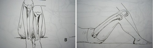 腰痠背痛.臀部痛.長短腳.坐骨神經痛.脊柱側彎.脊椎側彎.肩頸痠痛.脖子痛.肩膀痛.腳麻.腳痛.拇指外翻.足底筋膜炎.腳底筋膜炎.腳痛.腳跟痛.前腳掌痛.扁平足.高足弓.矯正.訂製鞋.高雄.鳳山.左營.jpg 腰痠背痛.臀部痛.長短腳.坐骨神經痛.脊柱側彎.脊椎側彎.肩頸痠痛.脖子痛.肩膀痛.腳麻.腳痛.拇指外翻.足底筋膜炎.腳底筋膜炎.腳痛.腳跟痛.前腳掌痛.扁平足.高足弓.矯正.訂製鞋.高雄.鳳山.左營.jpg