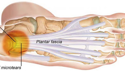 足底筋膜炎.後跟痛.足跟痛.腳底內側痛.腳後跟疼痛.早上起床痛.腳底筋膜炎.高雄鞋墊.量身訂製鞋墊.客製化鞋墊.足底筋膜炎鞋墊.足底筋膜炎治療.鞋墊推薦.足弓墊..足弓鞋墊.腳弓墊.矯正鞋墊.矯正墊.健康鞋 足底筋膜炎.後跟痛.足跟痛.腳底內側痛.腳後跟疼痛.早上起床痛.腳底筋膜炎.高雄鞋墊.量身訂製鞋墊.客製化鞋墊.足底筋膜炎鞋墊.足底筋膜炎治療.鞋墊推薦.足弓墊..足弓鞋墊.腳弓墊.矯正鞋墊.矯正墊.健康鞋