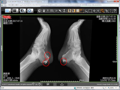 骨刺.腳底長骨刺.腳後跟疼痛 骨刺.腳底長骨刺.腳後跟疼痛