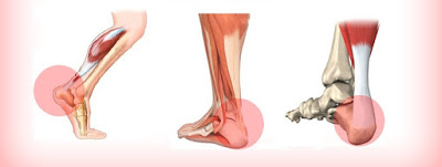 足底筋膜炎.後跟痛.足跟痛.腳底內側痛.腳後跟疼痛.早上起床痛.腳底筋膜炎.高雄鞋墊.量身訂製鞋墊.客製化鞋墊.足底筋膜炎鞋墊.足底筋膜炎治療.鞋墊推薦.足弓墊..足弓鞋墊.腳弓墊.矯正鞋墊.矯正墊.健康鞋 足底筋膜炎.後跟痛.足跟痛.腳底內側痛.腳後跟疼痛.早上起床痛.腳底筋膜炎.高雄鞋墊.量身訂製鞋墊.客製化鞋墊.足底筋膜炎鞋墊.足底筋膜炎治療.鞋墊推薦.足弓墊..足弓鞋墊.腳弓墊.矯正鞋墊.矯正墊.健康鞋