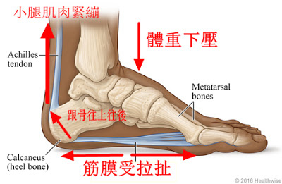 足底筋膜炎.後跟痛.足跟痛.腳底內側痛.腳後跟疼痛.早上起床痛.腳底筋膜炎.高雄鞋墊.量身訂製鞋墊.客製化鞋墊.足底筋膜炎鞋墊.足底筋膜炎治療.鞋墊推薦.足弓墊..足弓鞋墊.腳弓墊.矯正鞋墊.矯正墊.健康鞋 足底筋膜炎.後跟痛.足跟痛.腳底內側痛.腳後跟疼痛.早上起床痛.腳底筋膜炎.高雄鞋墊.量身訂製鞋墊.客製化鞋墊.足底筋膜炎鞋墊.足底筋膜炎治療.鞋墊推薦.足弓墊..足弓鞋墊.腳弓墊.矯正鞋墊.矯正墊.健康鞋