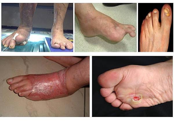 糖尿病-1 (1).jpg 糖尿病-1 (1).jpg