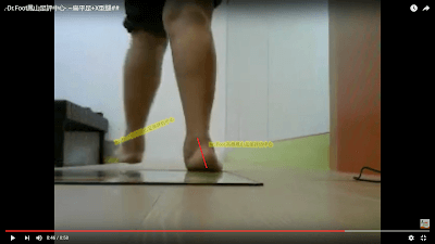 扁平足+跟骨外翻+X型腿_副本.png 扁平足+跟骨外翻+X型腿_副本.png