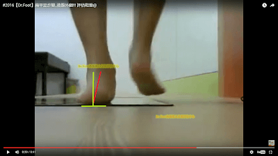 扁平足,跟骨外翻_副本.png 扁平足,跟骨外翻_副本.png