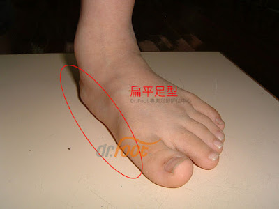 扁平足鞋墊.矯正鞋墊.足弓墊.客製化鞋墊.足弓塌陷.低足弓.量身訂製鞋墊.高雄鞋墊.扁平足腳痛鞋墊.jpg 扁平足鞋墊.矯正鞋墊.足弓墊.客製化鞋墊.足弓塌陷.低足弓.量身訂製鞋墊.高雄鞋墊.扁平足腳痛鞋墊.jpg