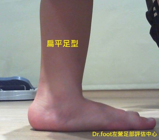 扁平足鞋墊.矯正鞋墊.足弓墊.客製化鞋墊.足弓塌陷.低足弓.量身訂製鞋墊.高雄鞋墊.扁平足腳痛鞋墊.扁平足矯正.JPG 扁平足鞋墊.矯正鞋墊.足弓墊.客製化鞋墊.足弓塌陷.低足弓.量身訂製鞋墊.高雄鞋墊.扁平足腳痛鞋墊.扁平足矯正.JPG