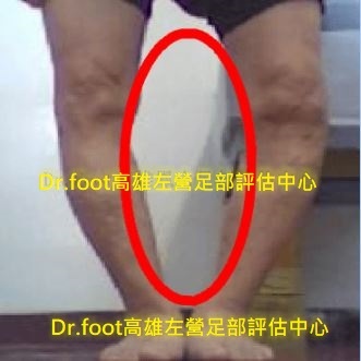 O型腿.O型腿矯正.O型腿鞋墊.JPG O型腿.O型腿矯正.O型腿鞋墊.JPG