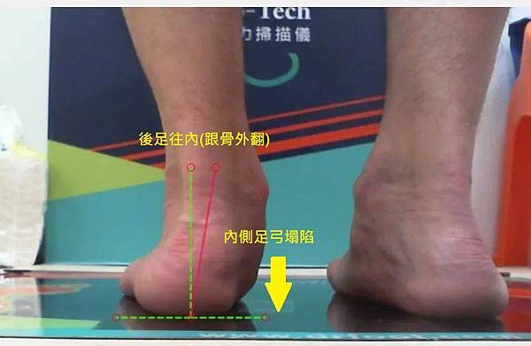 扁平足鞋墊.矯正鞋墊.足弓墊.客製化鞋墊.足弓塌陷.低足弓.量身訂製鞋墊.高雄鞋墊.扁平足腳痛鞋墊.扁平足矯正.足外翻.跟骨歪斜.跟骨內翻.跟骨外翻.jpg 扁平足鞋墊.矯正鞋墊.足弓墊.客製化鞋墊.足弓塌陷.低足弓.量身訂製鞋墊.高雄鞋墊.扁平足腳痛鞋墊.扁平足矯正.足外翻.跟骨歪斜.跟骨內翻.跟骨外翻.jpg