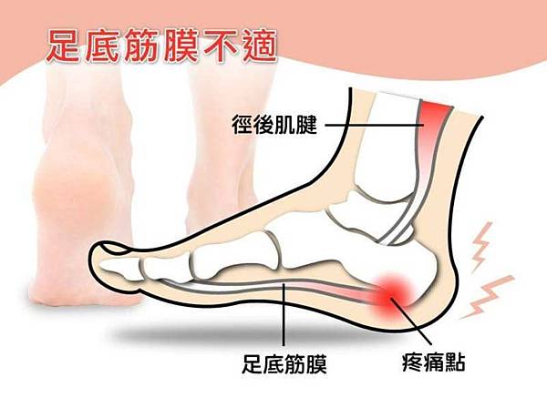 足底筋膜炎.後跟痛.足跟痛.早上起床痛.腳跟痛.高雄鞋墊.足底筋膜炎鞋墊.足底筋膜炎治療.jpg 足底筋膜炎.後跟痛.足跟痛.早上起床痛.腳跟痛.高雄鞋墊.足底筋膜炎鞋墊.足底筋膜炎治療.jpg